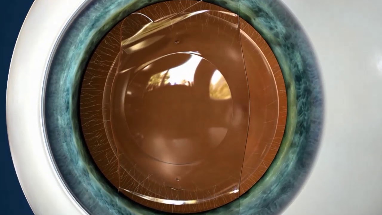 moed Continu Reflectie Implantable Contact lens – Ambaye Eye Care